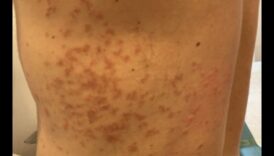 Ketonu loma autoimūnu ādas stāvokļu ārstēšanā