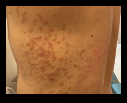 Ketonu loma autoimūnu ādas stāvokļu ārstēšanā